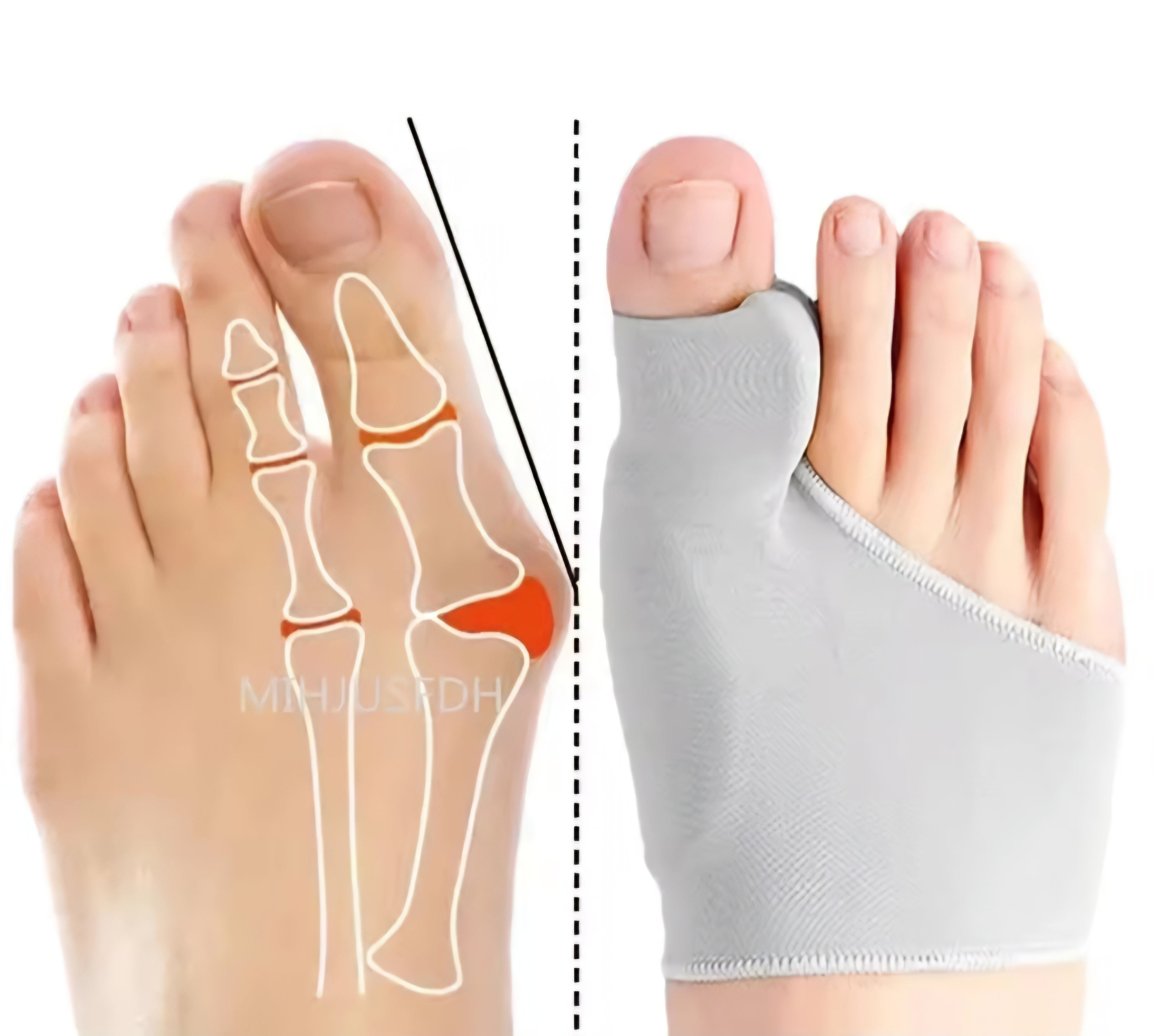 ToeAlign™ Orthopedic Night Splint